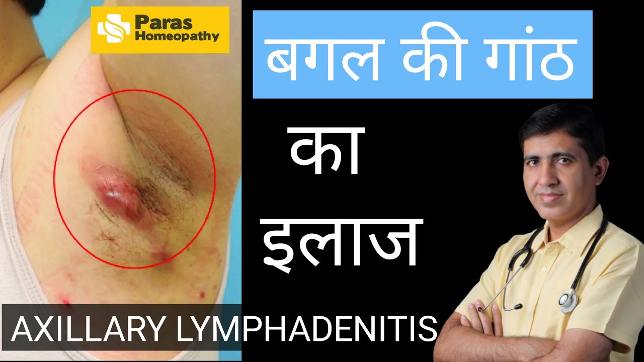 बगल की गाँठ Axillary Lymphadenitis Armpit Lymph Nodes Swollen