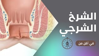 الشرخ الشرجي في أقل من 60 ثانية