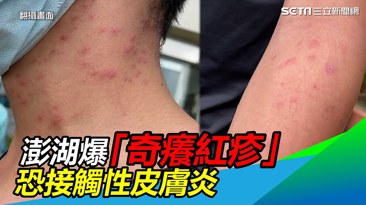 澎湖爆「奇癢紅疹」驚動CDC！非傳染病　恐接觸性皮膚炎｜三立新聞網 SETN.com - 天天要聞