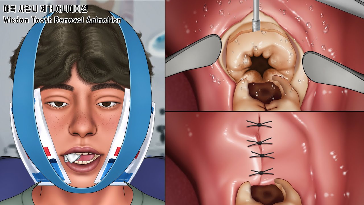 ASMR 매복 사랑니를 방치하면 안 되는 이유! 누워있는 사랑니 제거 애니메이션 | Wisdom Tooth Removal ...