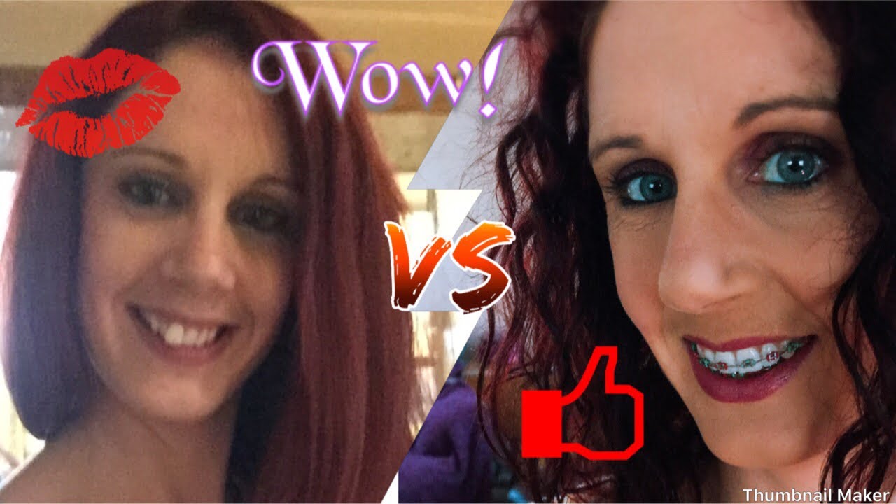 Orthodontist update for gummy smile and overbite, double jaw surgery