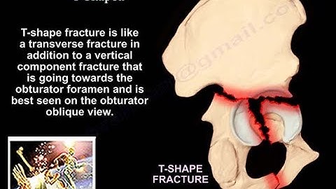 Acetabular Fracture T Shaped Fracture - Everything You Need To Know - Dr. Nabil Ebraheim