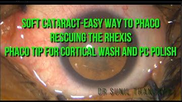 Soft cataract- easy phaco