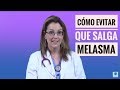 TRATAMIENTO MELASMA  ¿ES POSIBLE EVITAR QUE SALGA?