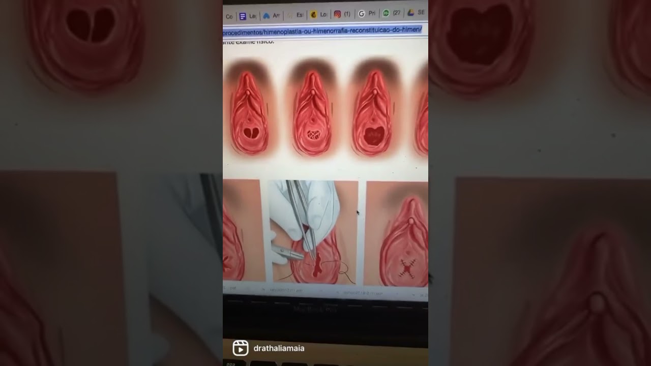 Tipos de Membrana Himenal | Dra. Thalia Maia | Grupo Elas | #shorts