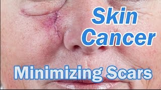 Elegant Skin Cancer Excision - Surgeon Minute