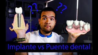 Implante dental vs Puente dental, cual es mejor??   Dr. Juan Tobar