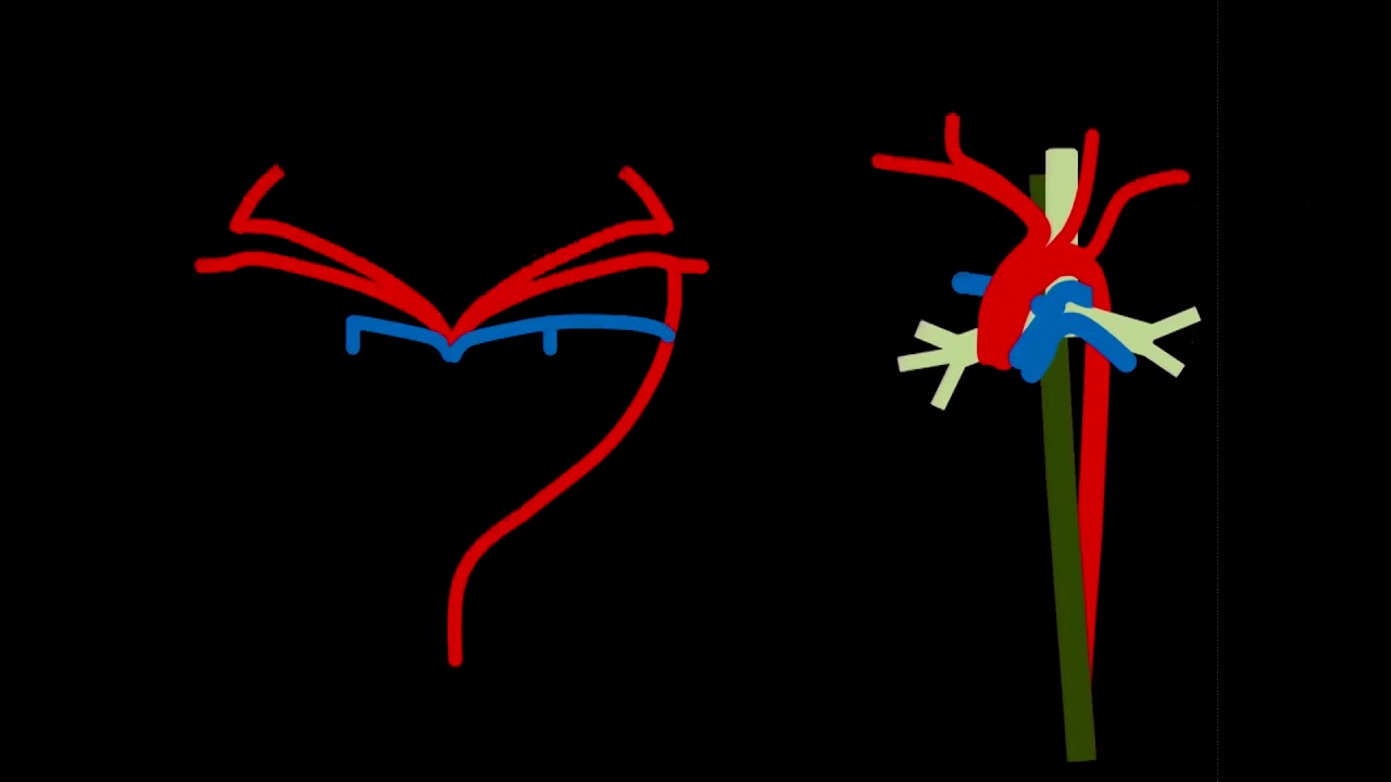 Aortic arch anomalies