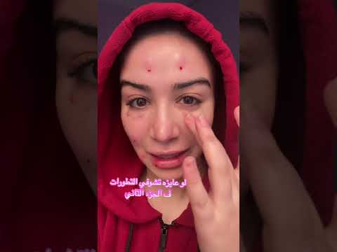 حقنه النضاره