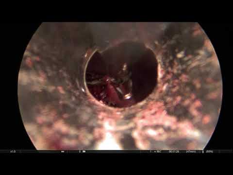 Laparoskopinė apendektomija dėl flegmoninio apendicito (vaikams)