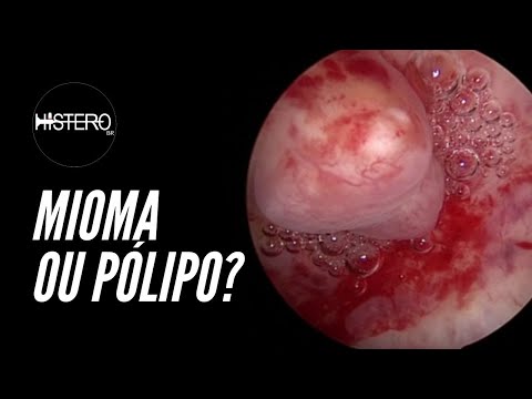 Histeroscopia Cirúrgica - Mioma ou Pólipo Endometrial? Cirurgia Comentada
