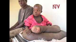 10Yr Old Fights Abnormal Leg Swellings