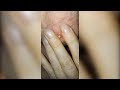 Popping huge blackheads and pimple popping  best pimple poppings 17