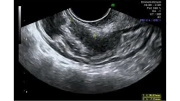 ¿Se puede ver la endometriosis en una ecografía?