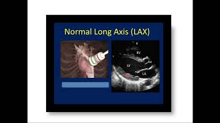 ECHO BASICS |BASICS OF ECHO| ECHOCARDIOGRAPHY