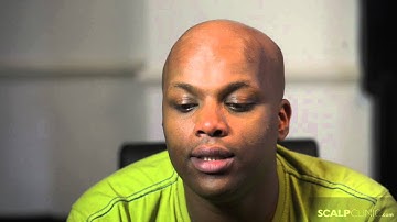 Scalp Micropigmentation at Scalp Clinic -- Bile