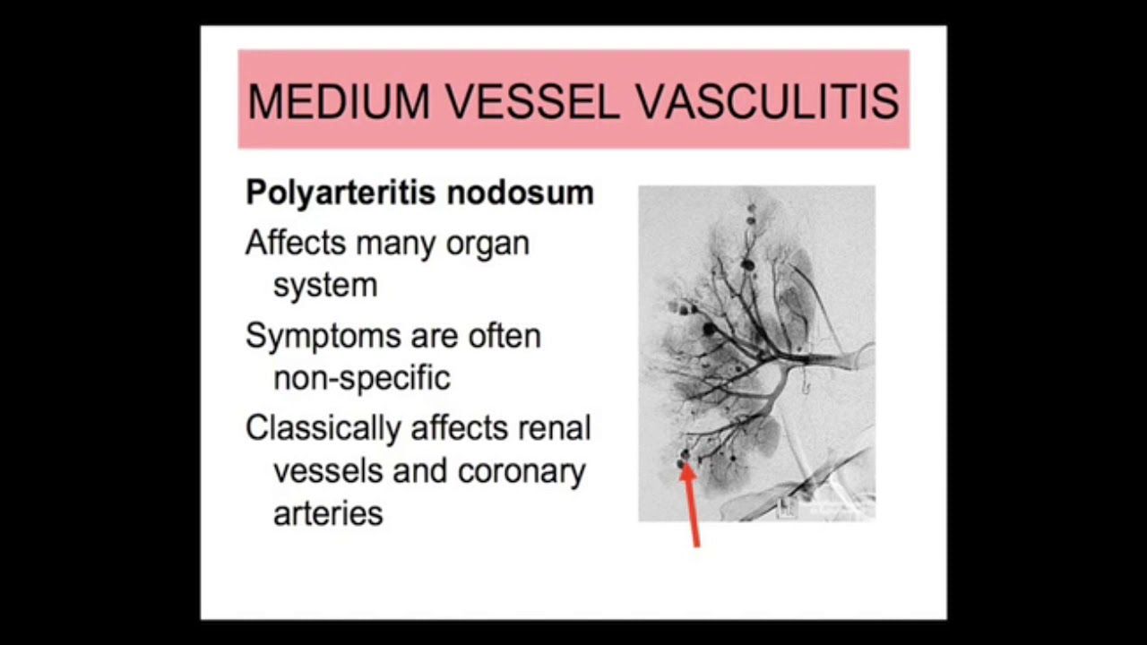 Rheumatology - vasculitides