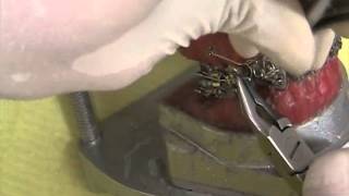 Double Key Loops and Microscrew Implant Anchorage.