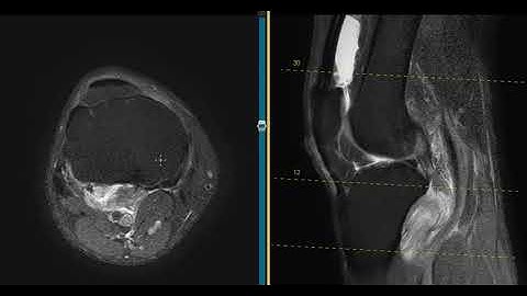 Compartment syndrome in calf