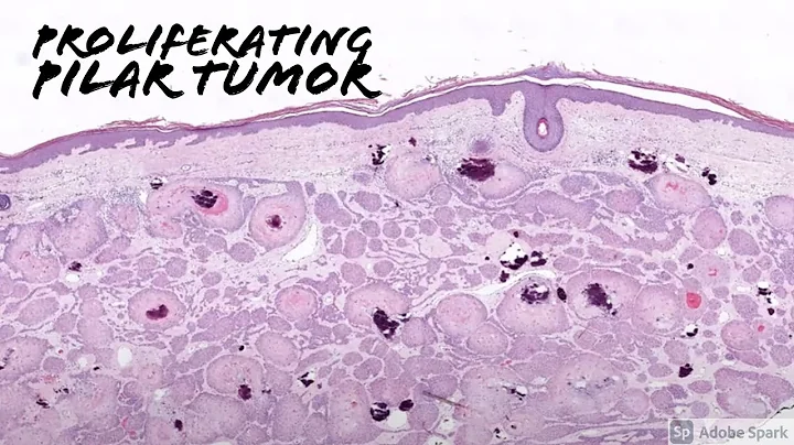 Proliferating Pilar Tumor/Proliferat...  Trichilem...