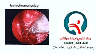 Antrochoanal polyp at مركز_الخريبي جراحات مناظير الأنف الأذن الحنجرة