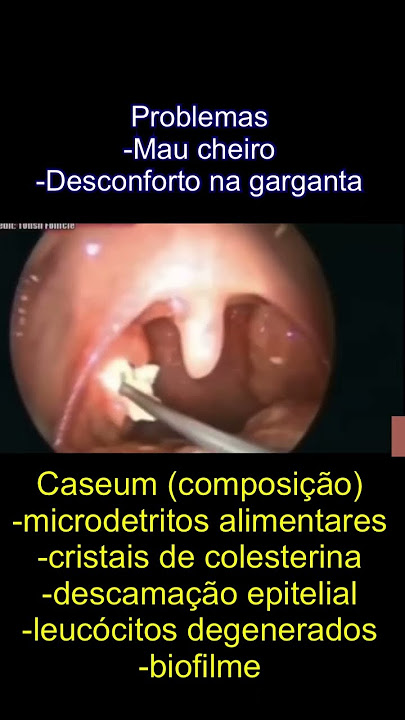 Caseum: bolinha branca na garganta. Causas, prevenção e como