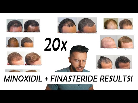 20 Finasteride and Minoxidil before and after Results!!! NW2 -