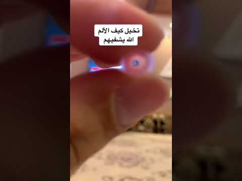 إبرة غسيل الكلى أسأل الله أن يشفيهم