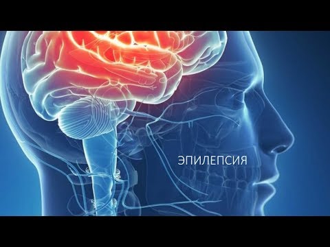 Эпилепсия - причины, симптомы и диагностика