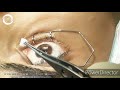 Refractive Surgery Trans PRK