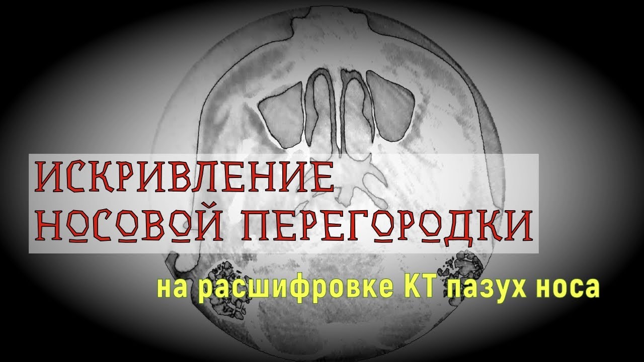 ИСКРИВЛЕНИЕ НОСОВОЙ ПЕРЕГОРОДКИ и ОТЕК гайморовой пазухи на расшифровке КТ пазух носа