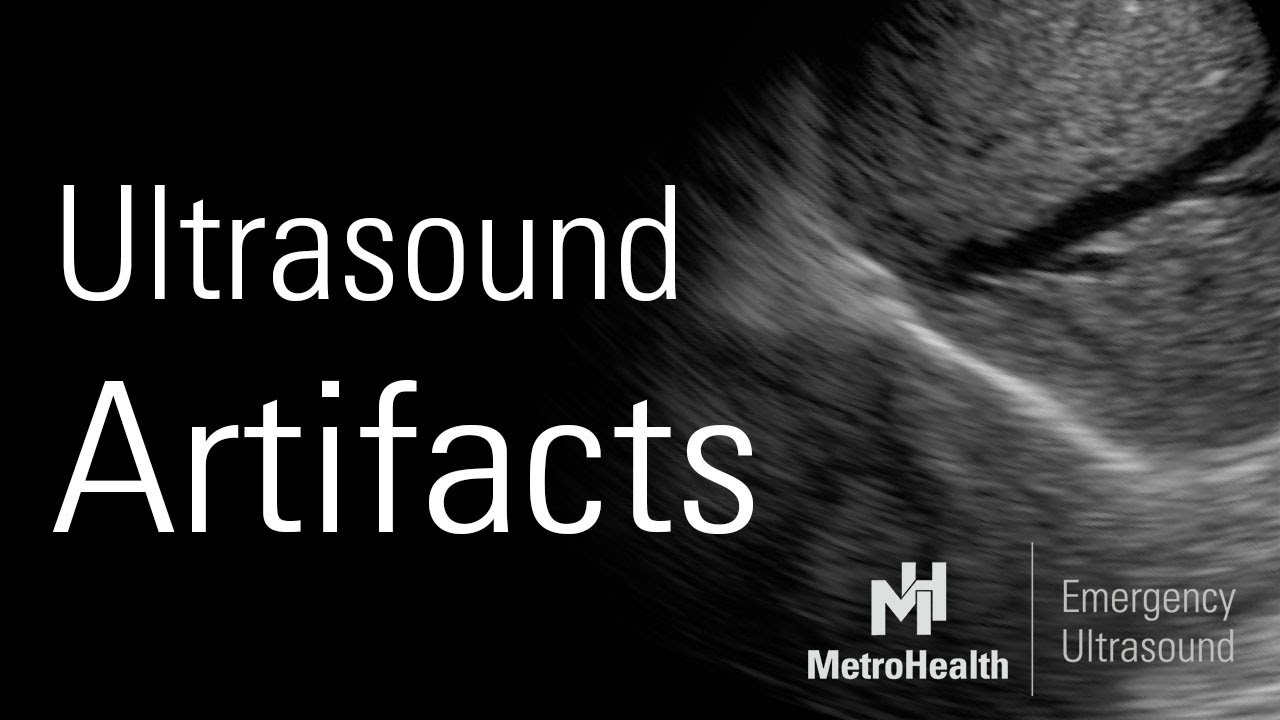 Ultrasound 101 – Part 8: Artifacts in Ultrasound | 123 Sonography