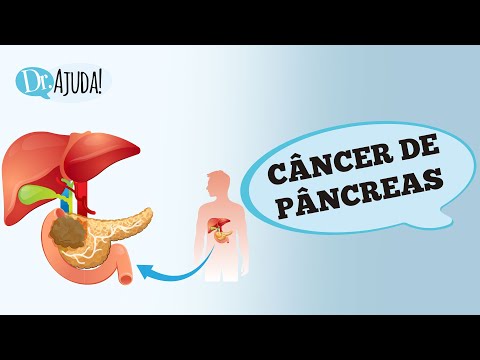 Vídeo: Como diagnosticar câncer de pâncreas: 14 etapas (com fotos)