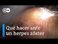 Primero varicela, luego herpes zóster