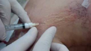 Long island nylon escleroterapia