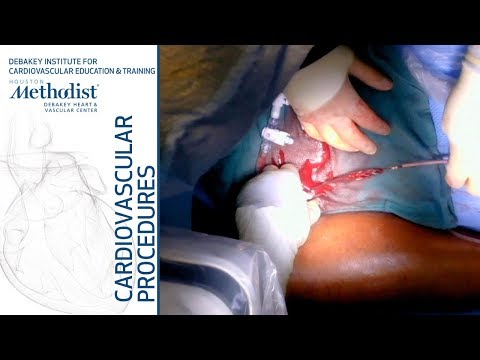 Video: Thrombectomy - Types Of Surgery, Indications, Results