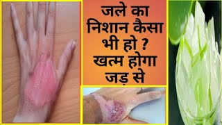 How to remove Burn Scar | Aag,Tel se jalne par kya kare/Jale, kate, fate ya Fafole ke nishan khatm