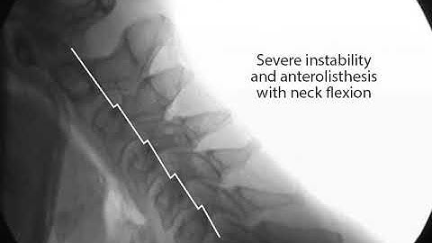 Cervical Instability Before and After H3 Prolotherapy