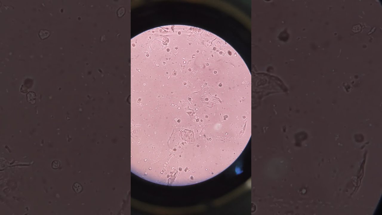 Bacterial flora in Urine Examination.