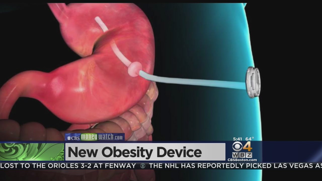 New Obesity Device Drains Calories From Stomach - YouTube