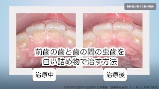 前歯の虫歯 前歯の歯と歯の間の虫歯を裏側から虫歯を取り 目立たず白い詰め物で治す方法 Youtube