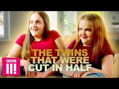 The Twins That Were Cut In Half | Living Differently