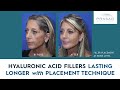 How Facial Cosmetic Fillers can Last Longer with Placement Technique