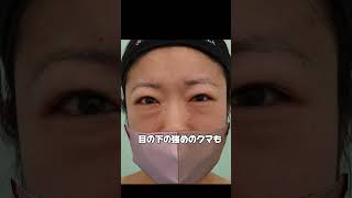 #裏ハムラ法 の名医　#形成外科専門医 #くまとり #目の下のクマ