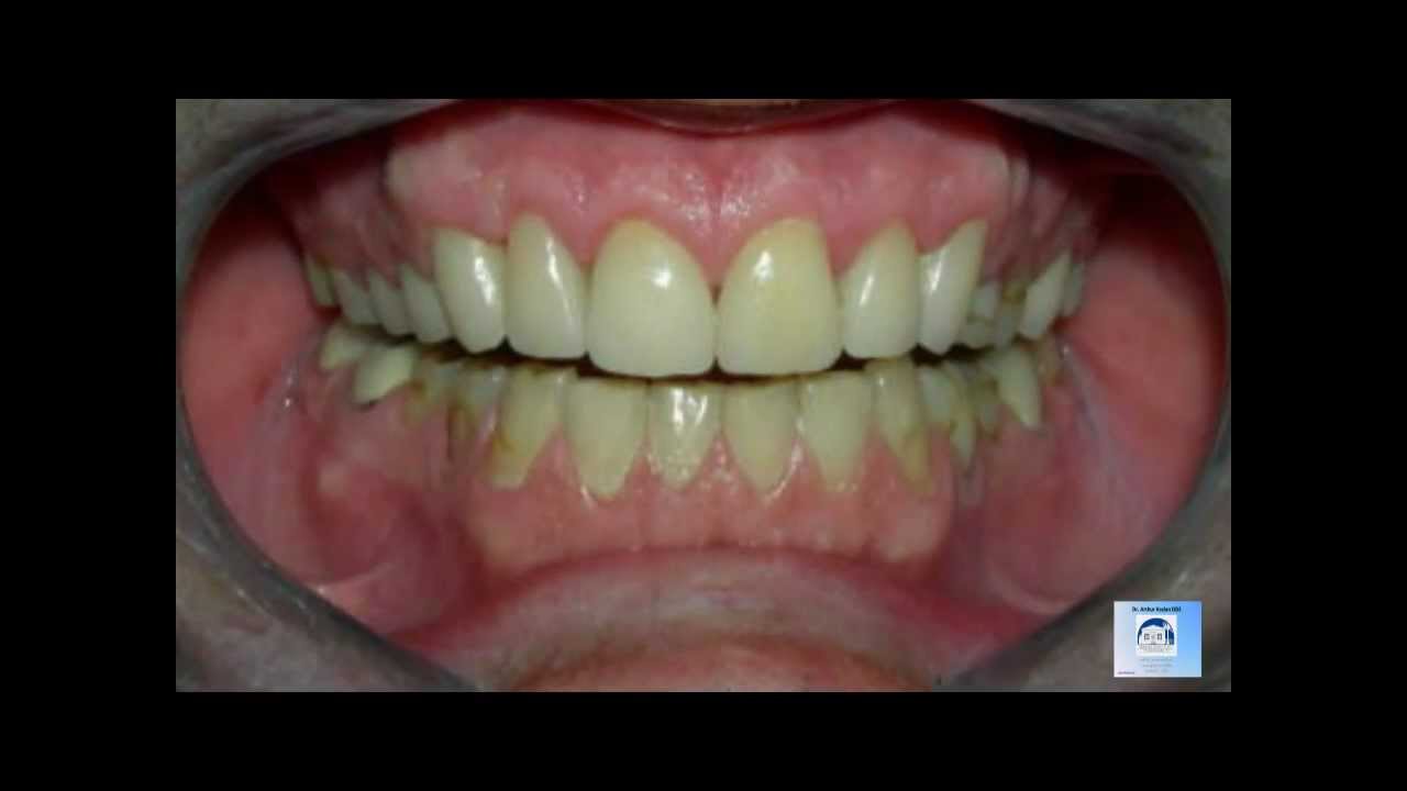Porcelain Crowns by a Los Angeles Dentist 8-13 s