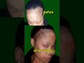 watch what happened at 8 weeks .#hairline #fyp #shumiehairlinebooster #shorts