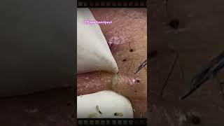 Relax Blackhead Removal 082  shorts  blackhead  acne  pimplesremoval  satisfying