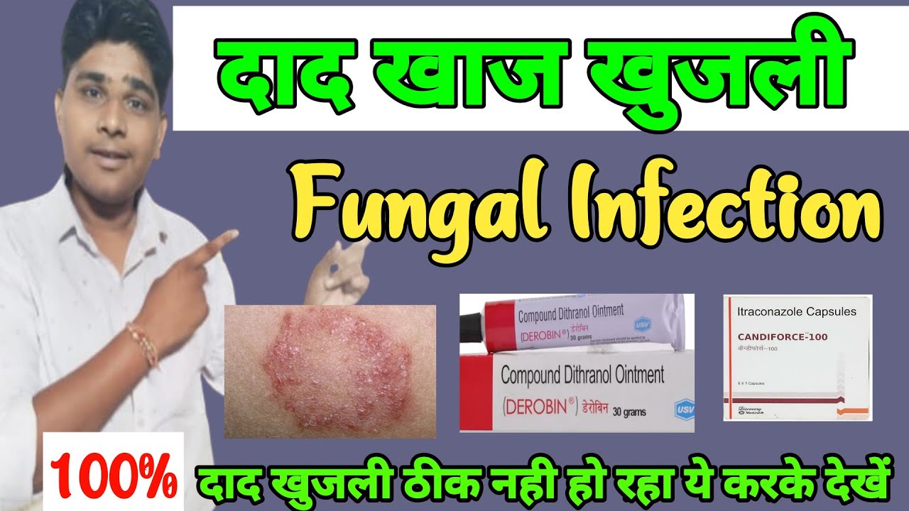 दाद खाज खुजली को जड़ से ख़तम कैसे करे? Dad Khaj Khujli Ki Dawa fungal