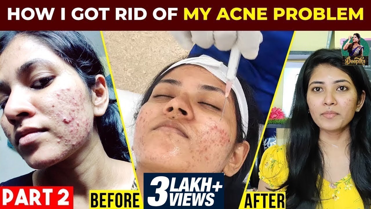 How I Got rid of my Acne Problem - Part 2 | Detailed Treatment | Clear ...