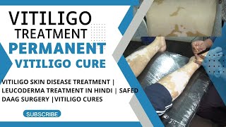 VITILIGO SKIN DISEASE TREATMENT | LEUCODERMA TREATMENT IN HINDI | SAFED DAAG SURGERY |VITILIGO CURES